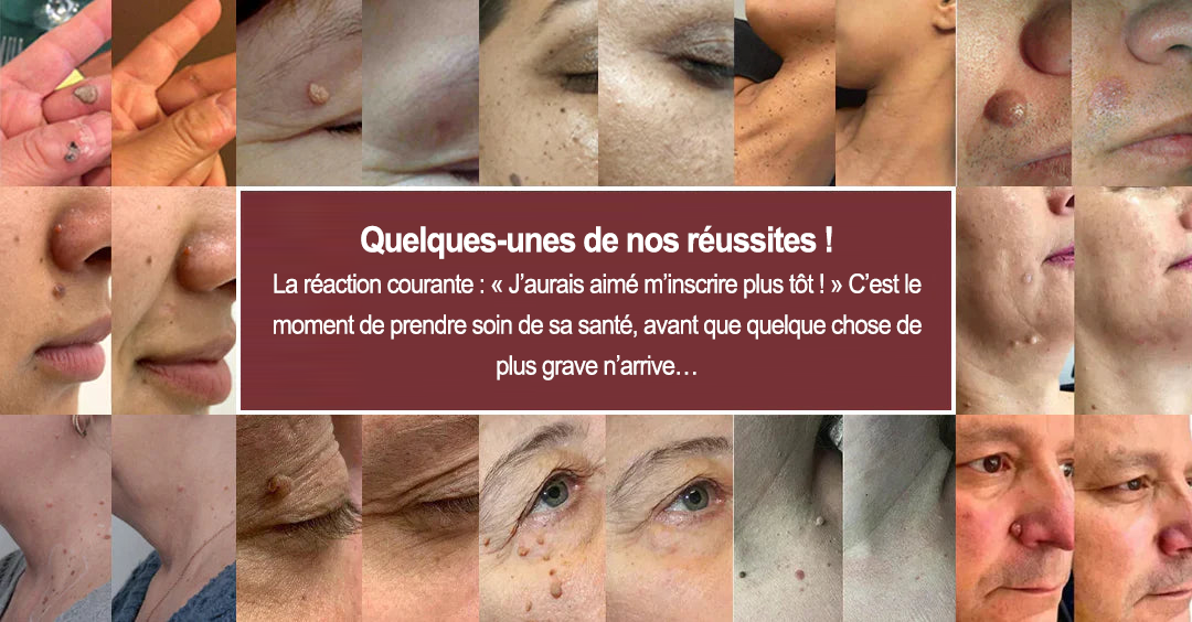 🏥Patch 2-en-1 Curalona® : Microneedle & Hydrocolloïde🍀 | Élimine les grains de beauté en relief, les verrues planes et les acrochordons | Aide à atténuer les rides, les cicatrices et les imperfections | Patch invisible adapté au visage et au corps