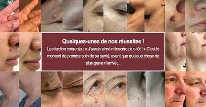 🏥Patch 2-en-1 Curalona® : Microneedle & Hydrocolloïde🍀 | Élimine les grains de beauté en relief, les verrues planes et les acrochordons | Aide à atténuer les rides, les cicatrices et les imperfections | Patch invisible adapté au visage et au corps