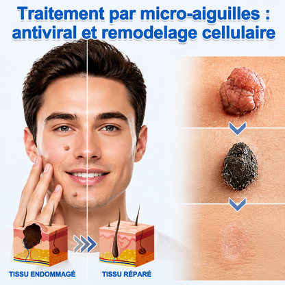 🏥Patch 2-en-1 Curalona® : Microneedle & Hydrocolloïde🍀 | Élimine les grains de beauté en relief, les verrues planes et les acrochordons | Aide à atténuer les rides, les cicatrices et les imperfections | Patch invisible adapté au visage et au corps